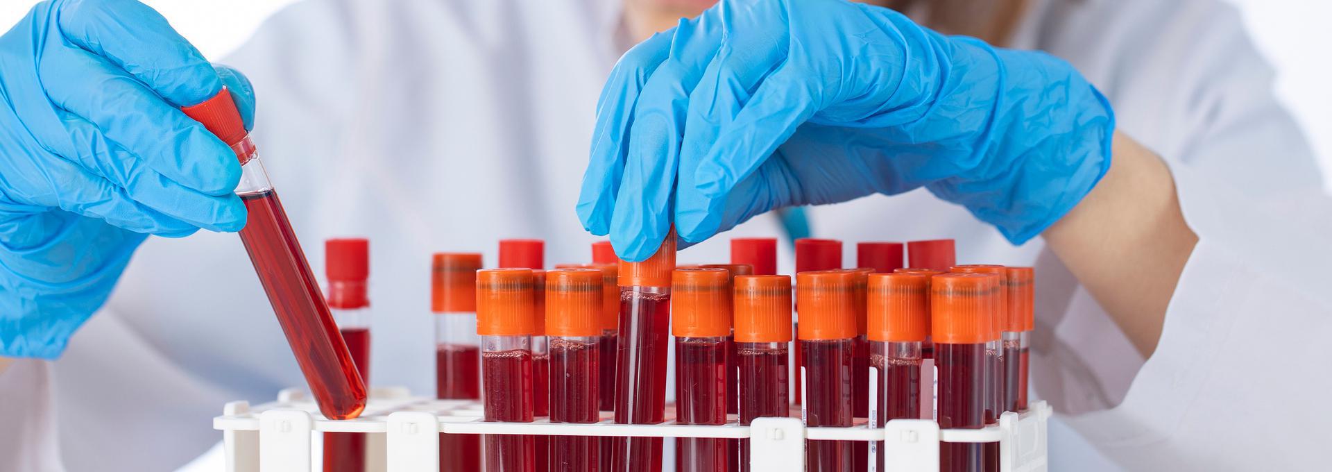 Hepatitis C Antibody Test Hepatitis C Antibody Test - info-hero
