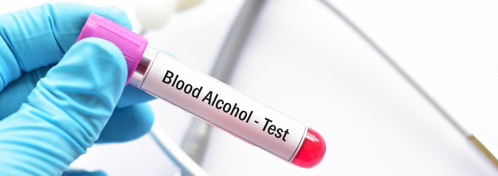 Peth Alcohol Test